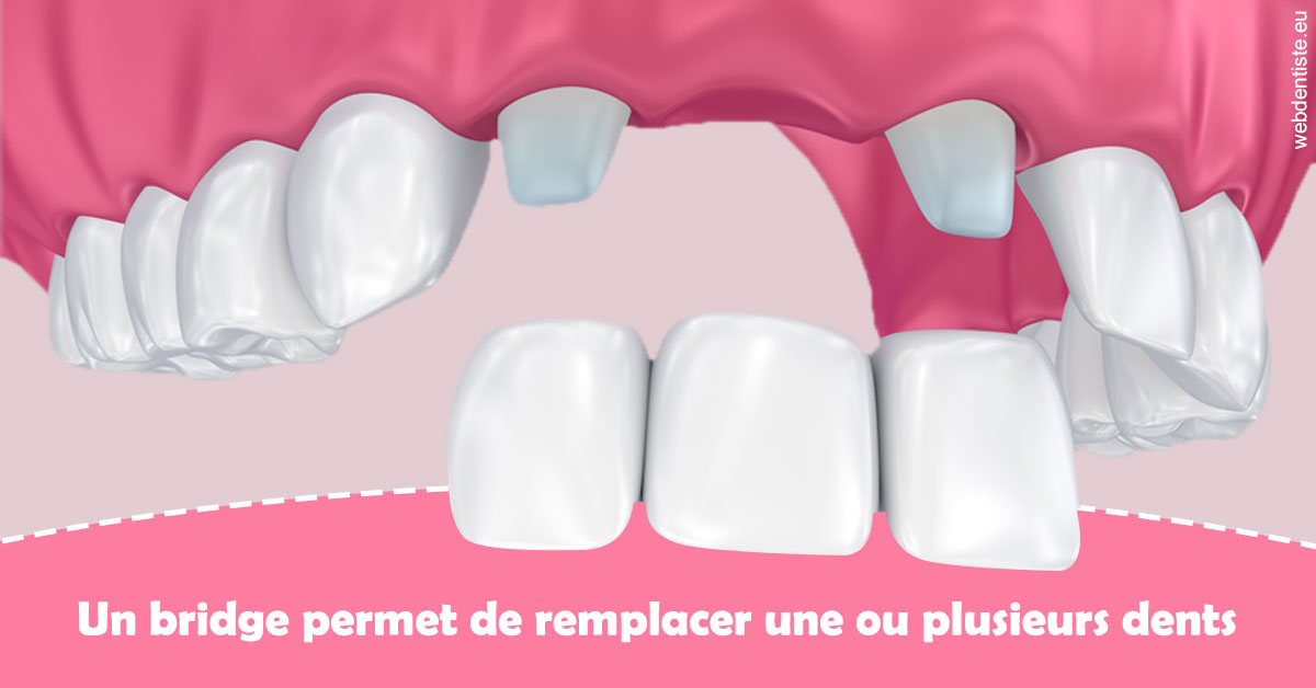 https://selarl-haussmann-setbon.chirurgiens-dentistes.fr/Bridge remplacer dents 2