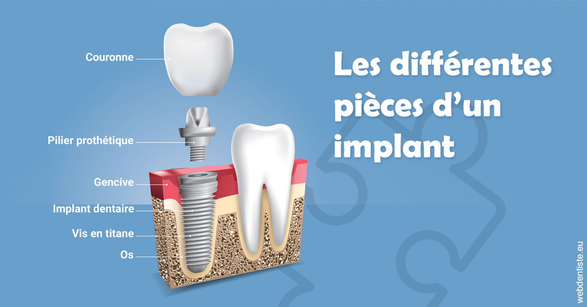 https://selarl-haussmann-setbon.chirurgiens-dentistes.fr/Les différentes pièces d’un implant 1